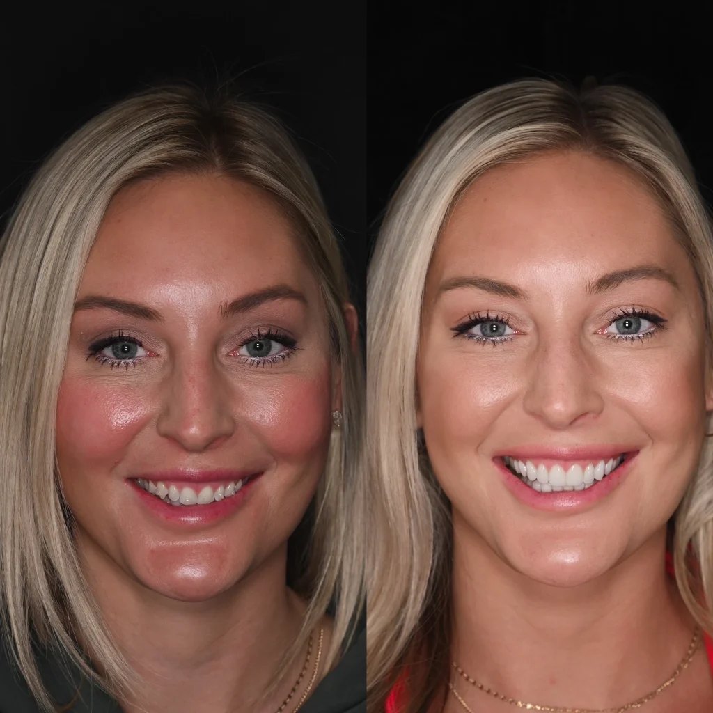Before and after a smile makeover in Tennessee at Dentistry of Lewisburg by Dr. Skylor Morton