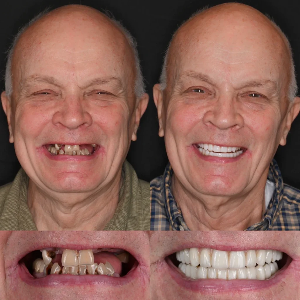 Before and after dental implants in Lewisburg, TN at Dentistry of Lewisburg