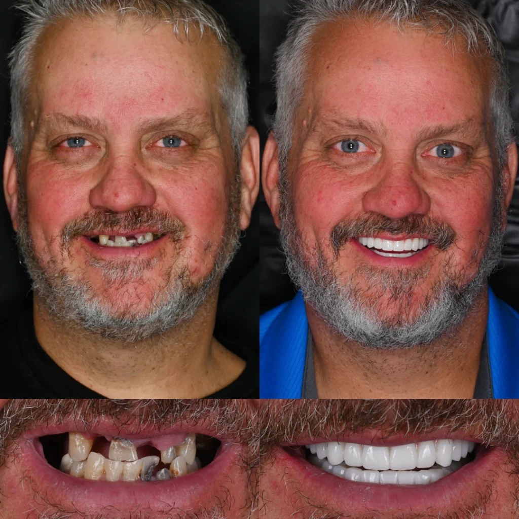 Before and after dental implants in Lewisburg, TN at Dentistry of Lewisburg