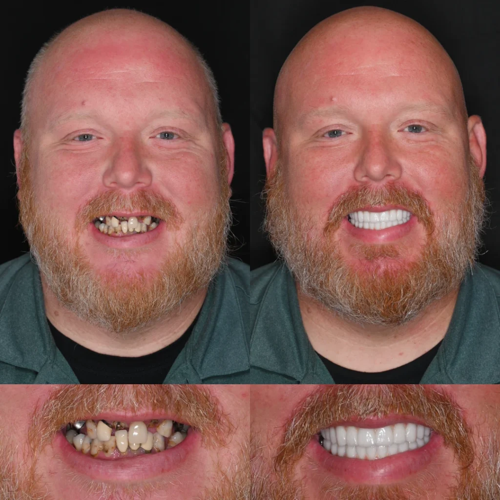 Before and after dental implants in Lewisburg, TN at Dentistry of Lewisburg