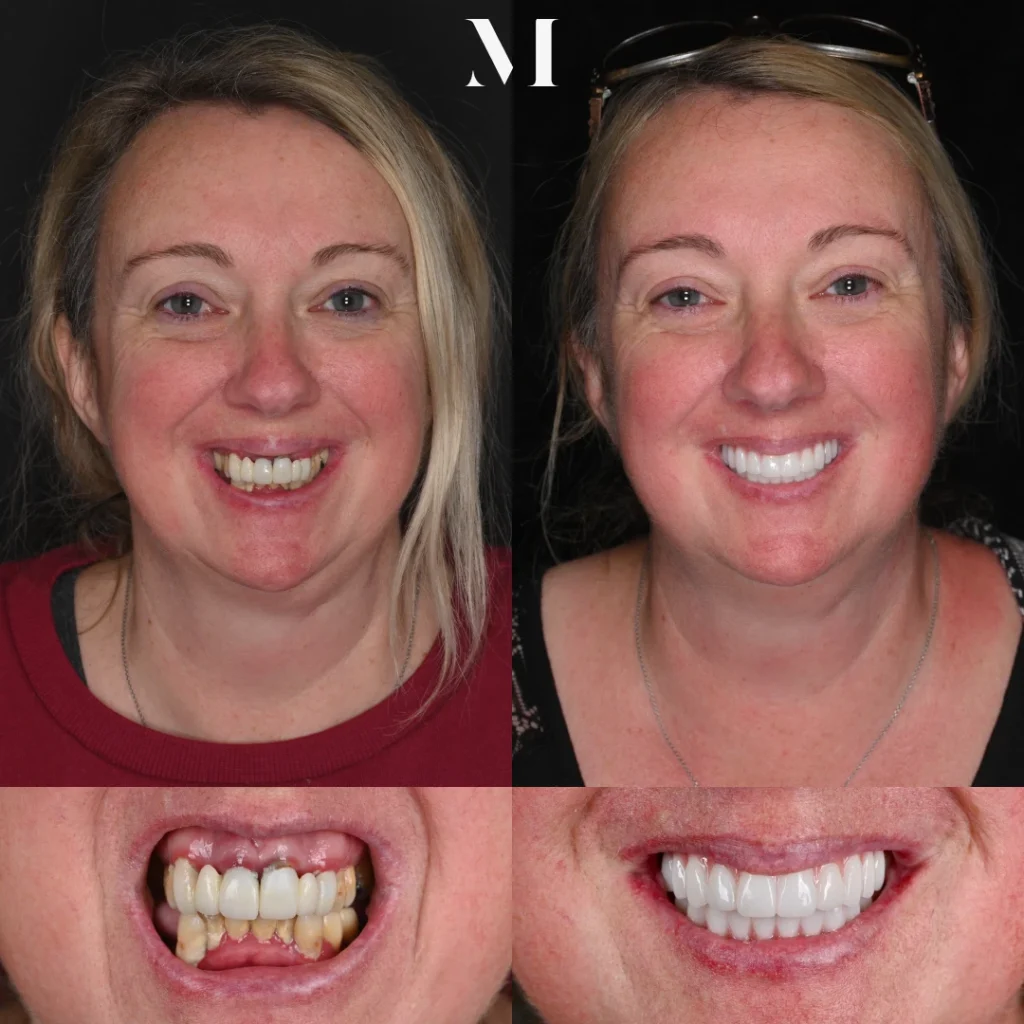 Before and after dental implants in Lewisburg, TN at Dentistry of Lewisburg